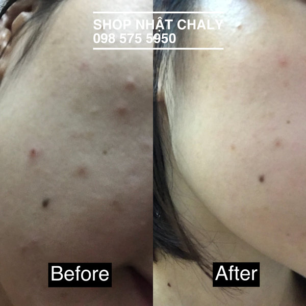 Mặt nạ sake kasu face mask review: có thể giảm viêm và mụn khá tốt cho da