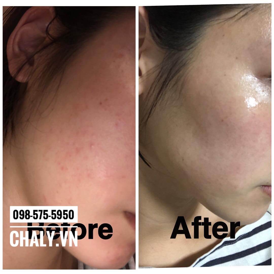 Sau 3 tháng dùng kem trị mụn Dalacin T Gel