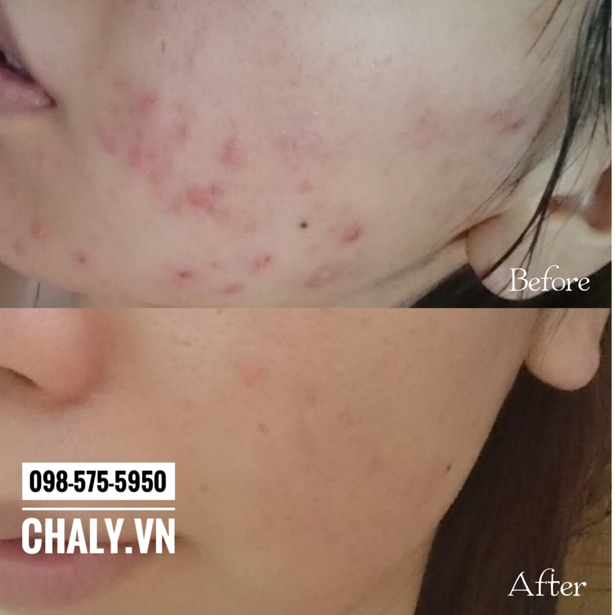 Sau 5 tháng dùng kem trị mụn Dalacin T Gel 1%