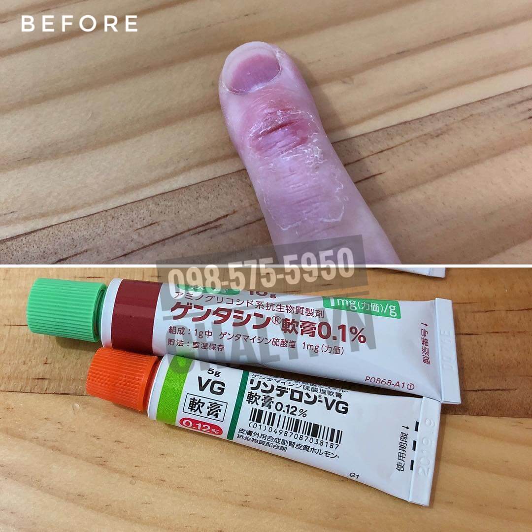 Vùng da viêm sần, có sẹo cứng được trị khỏi nhờ thoa kem Gentacin 0.1%