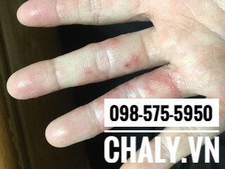 Ngoài trị mụn sẹo thì các vùng da cứng, sần như thế này cũng được cải thiện rõ rệt khi sử dụng Gentacin 0.1% Nhật