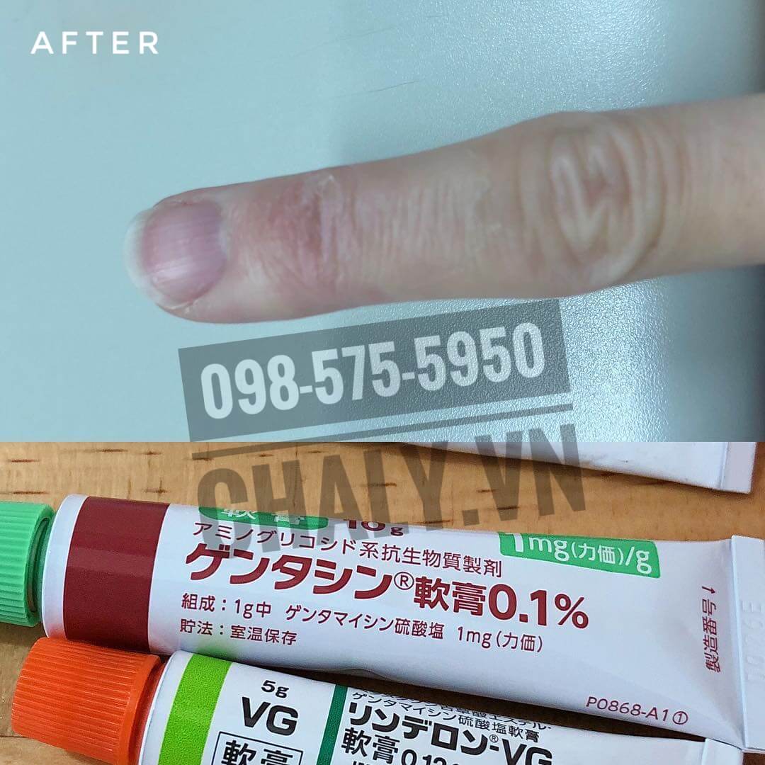 Vùng da viêm sần, có sẹo cứng được trị khỏi nhờ thoa kem Gentacin 0.1%