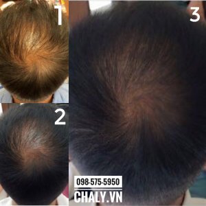 Ảnh từ review thực tế của người dùng Nhật khi sử dụng Yanagiya hair tonic. Từ ảnh 1 tới 2, 3 có thể thấy lượng tóc mọc dày và rậm hơn rất nhiều khi dùng lotion mọc tóc Nhật Bản