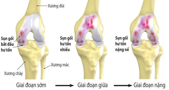 Tình trạng đau nhức xương khớp nếu không được xử lý sớm sẽ ngày càng trở nặng gây khó khăn cho việc đi lại