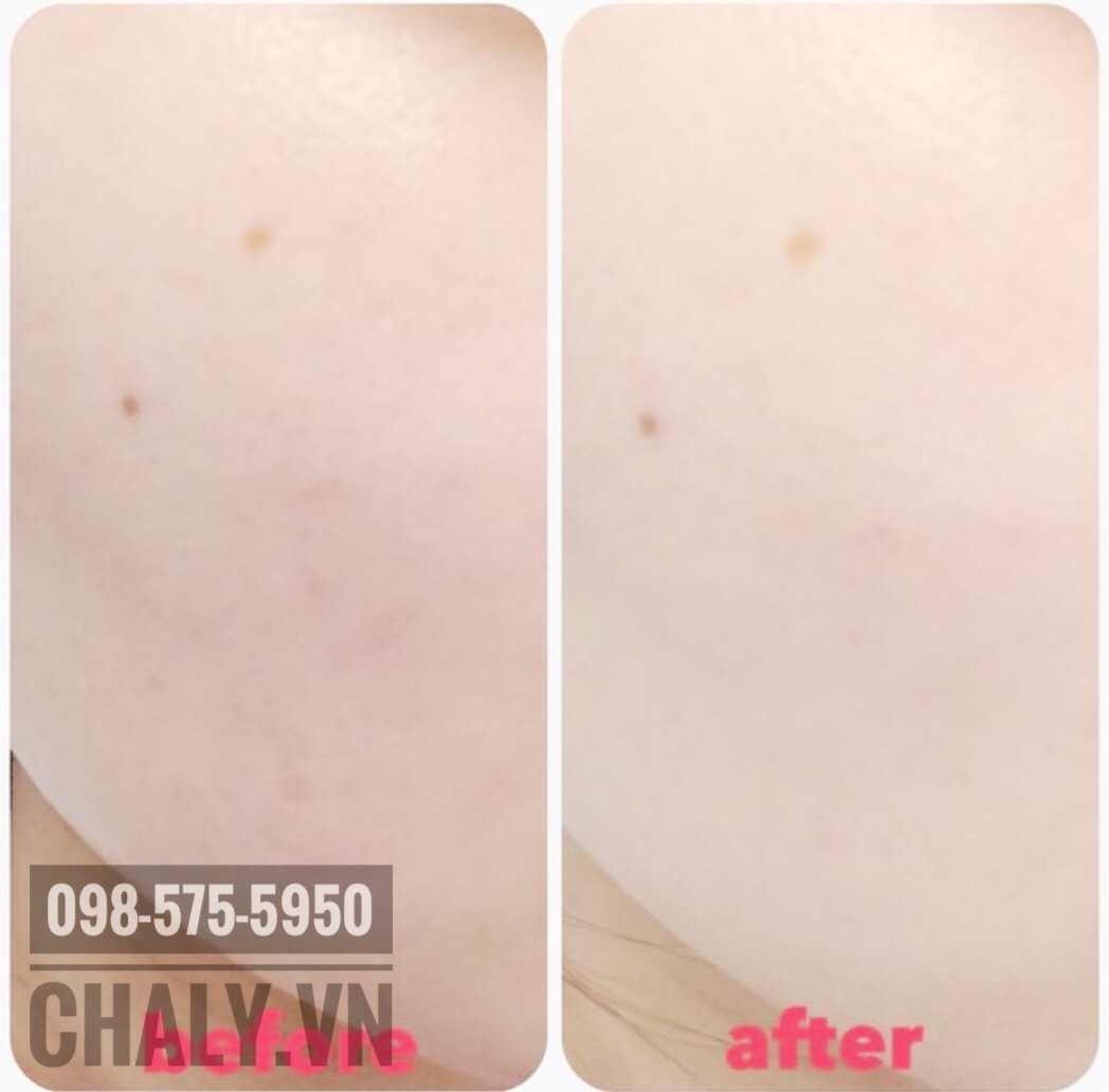 Mình sử dụng mặt nạ tsururi nhật được 2 tuần thấy giảm hẳn mụn luôn