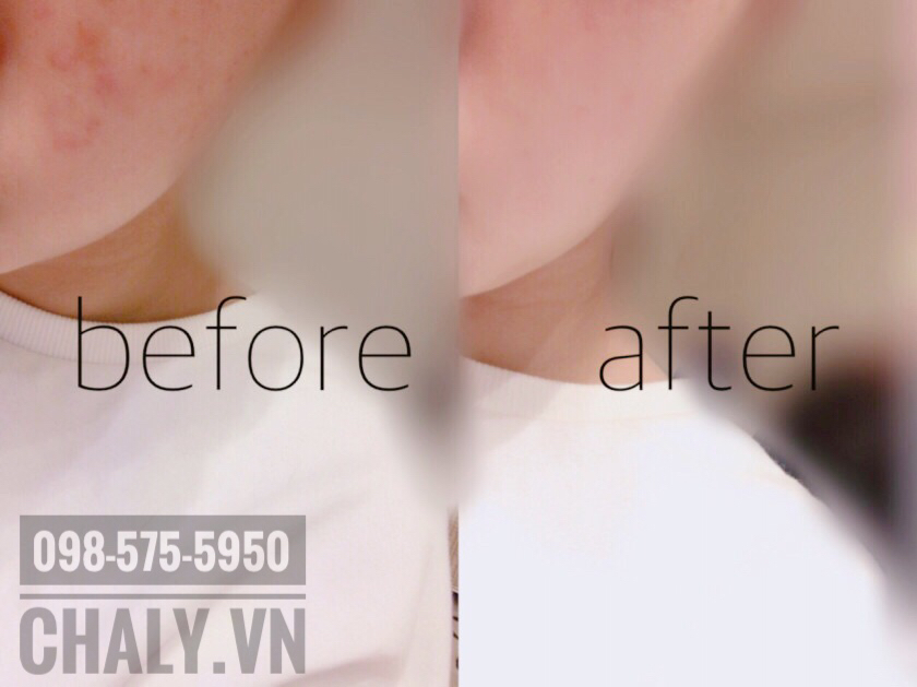 DHC Acne Control Review: Da đỡ hẳn mụn sau khoảng 2 tuần dùng liên tục
