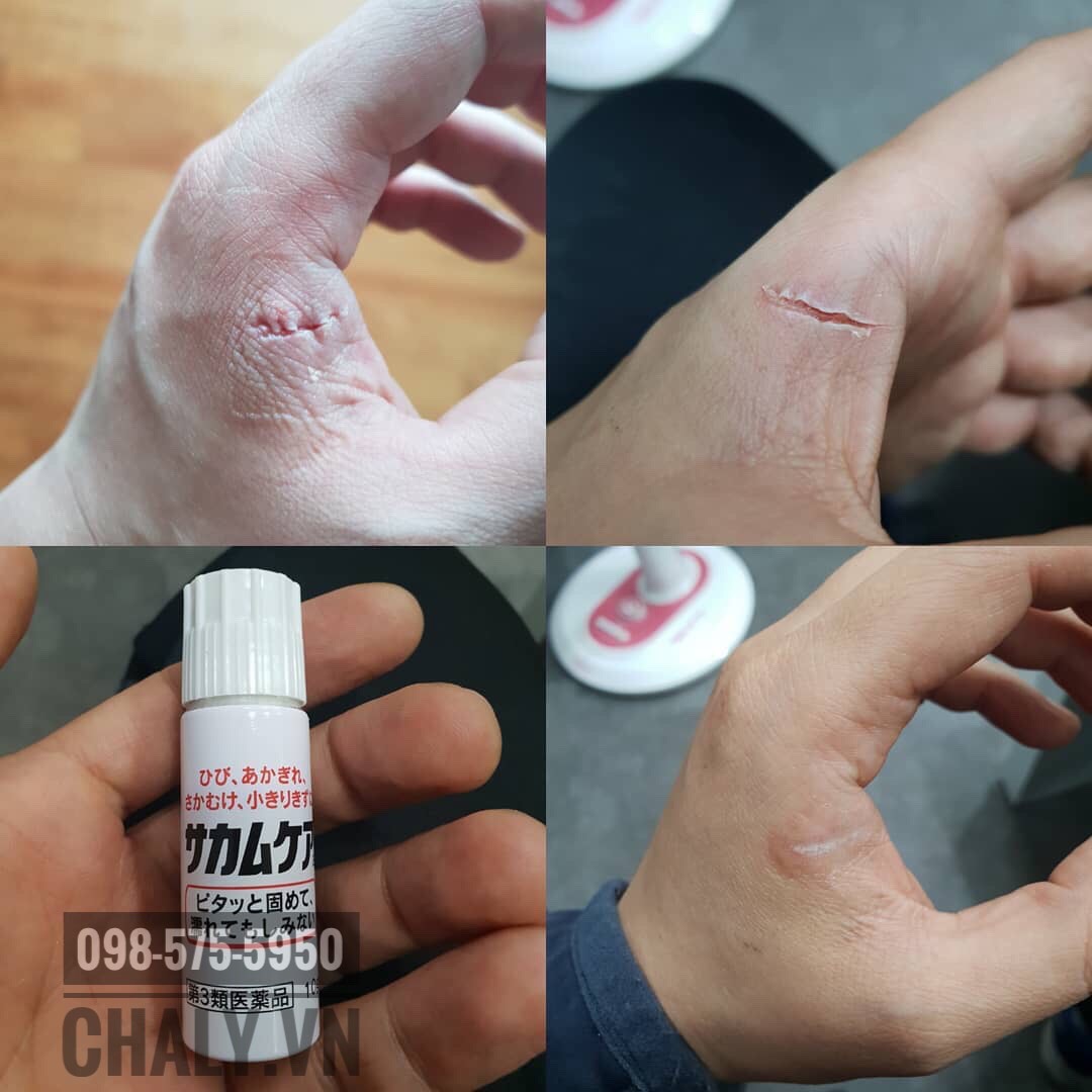 Mình rất chuộng xử lý vết thương trầy xước tay chân bằng băng dán vết thương của nhật dạng gel kobayashi sakamucare vì hiệu quả