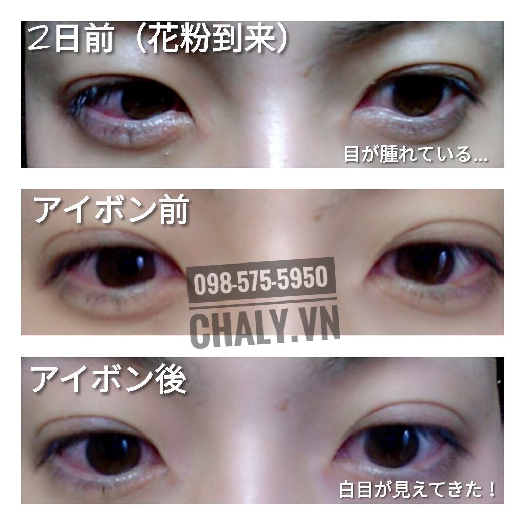 Dùng thuốc rửa mắt của Nhật Eyebon W Vitamin chỉ 1 ngày giúp trị khỏi ngay tình trạng viêm mắt do dị ứng phấn hoa