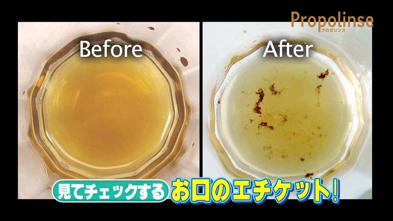Sử dụng nước súc miệng Propolinse Nhật Bản cho ra các mảng bám kết tủa như thế này
