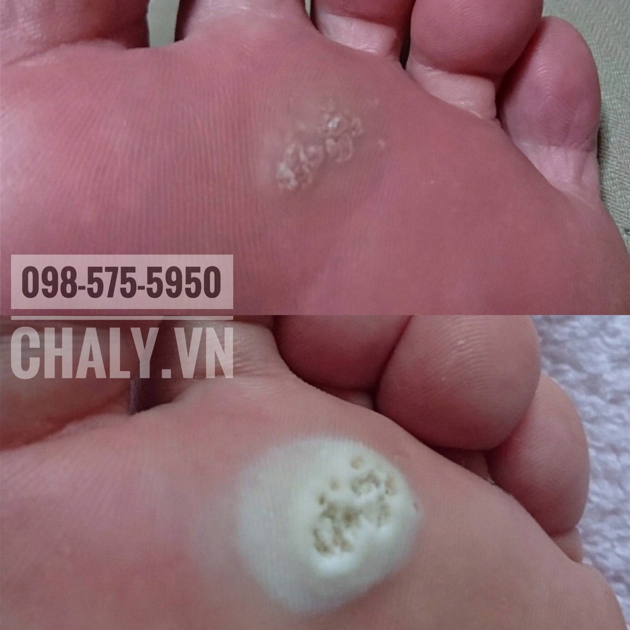 Khi nhỏ dung dịch trị mụn cóc Nhật Bản lên vùng da sần thì da sẽ chuyển màu trắng