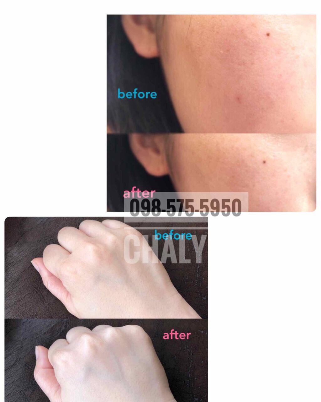 Trước và sau khi dùng kem chống nắng skin aqua cho da mụn nhạy cảm mới 2019