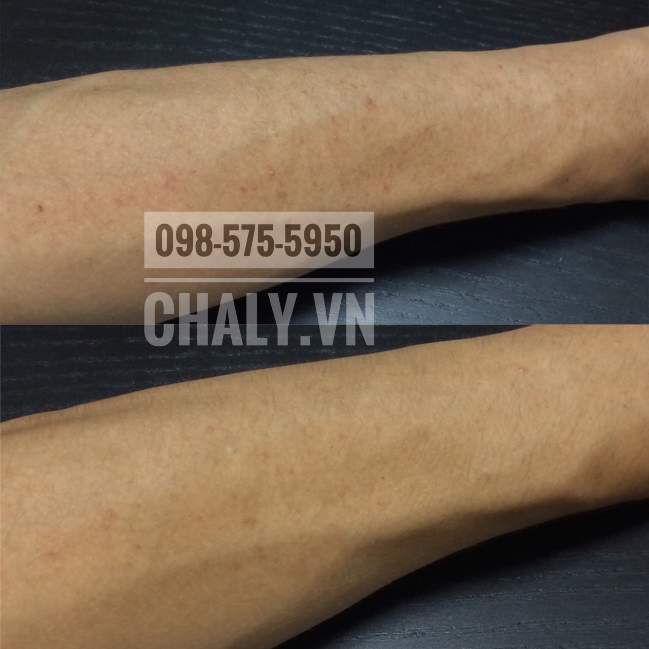 Kết quả 2 tuần thoa kem trị viêm lỗ chân lông của Nhật Kobayashi Nino Cure skincare cream