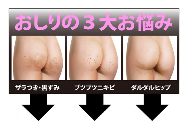 3 nhược điểm phổ biến của vùng mông: Mông thâm đen - Mông có mụn sần - Mông có nếp nhăn và chảy xệ đều có thể cải thiện bằng cách dùng kem Miwaku no Oshiri của Nhật