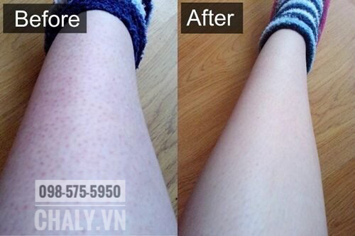 Hiệu quả sau khi sử dụng kem trị viêm nang lông của Nhật