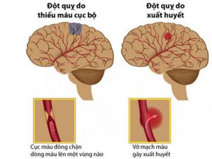 Có hai loại đột quỵ: Thiếu máu (is-KEEM-ik) và Xuất huyết (hem-o-RAJ-ik)