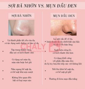 Rất nhiều nàng hay nhầm lẫn giữa sợi bã nhờn và mụn đầu đen