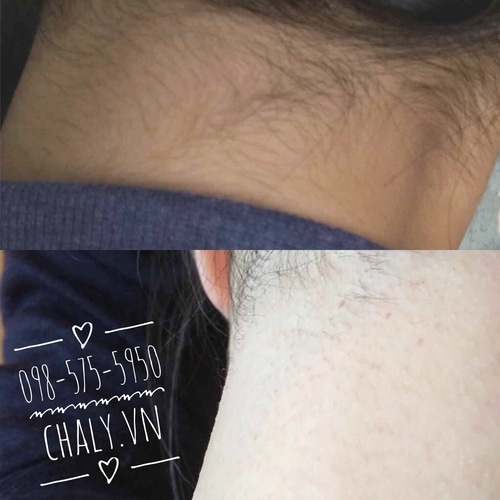 Để tẩy lông vùng gáy thế này thì thực sự ngoài miếng dán wax lông ra chắc không còn cách nào khác. Dùng xong da hơi châm chích nhẹ nhưng mai là hết, khá oke