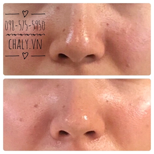 Sử dụng toner CC Melano của Rohto Nhật sau 2 tuần giúp lỗ chân lông và mụn đầu đen đều cải thiện, da căng mướt hơn