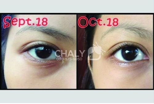 Chỉ sau 1 tháng sử dụng kem trị thâm mắt Nhật Kumargic eye cream 20g thì quầng thâm đã giảm đi đáng kể